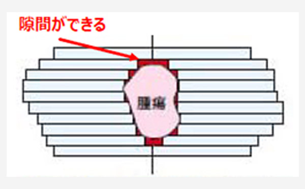 前立腺癌全摘出術後の臨床的再発