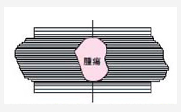 前立腺癌全摘出術後の臨床的再発