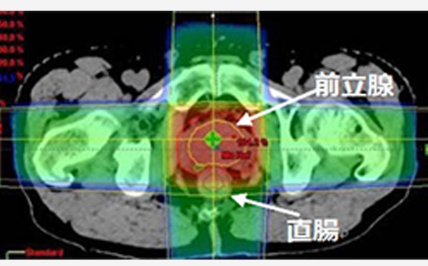 前立腺癌全摘出術後の臨床的再発