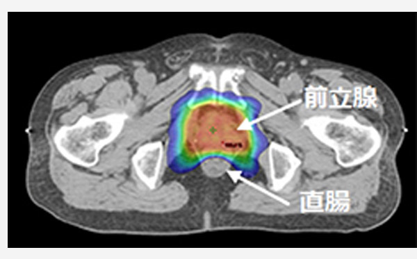 前立腺癌全摘出術後の臨床的再発