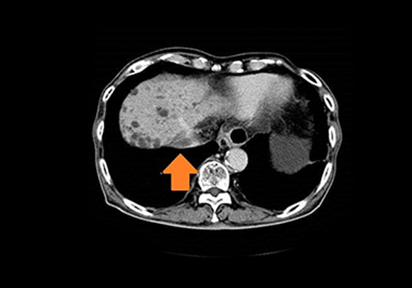 前立腺的再発