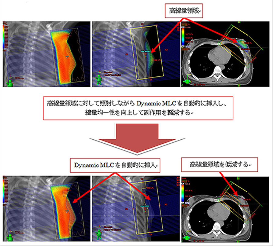 図３．乳房温存放射線療法（接線照射）におけるField in Field法（例）