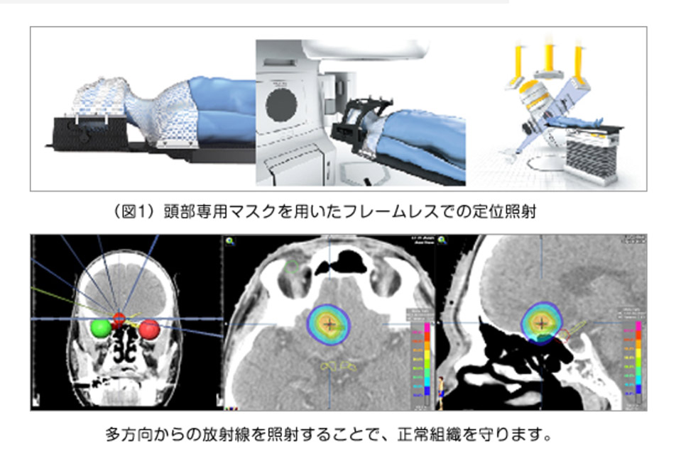 マルチリーフコリメータ（MLC）