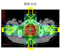 高精度放射線治療装置 ノバリス-Tx