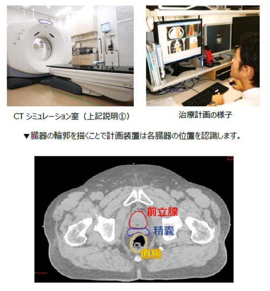 強度変調放射線治療