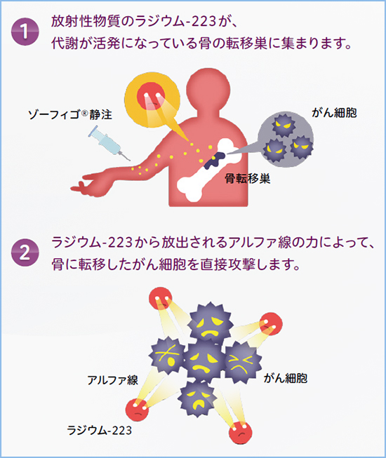 マルチリーフコリメータ（MLC）