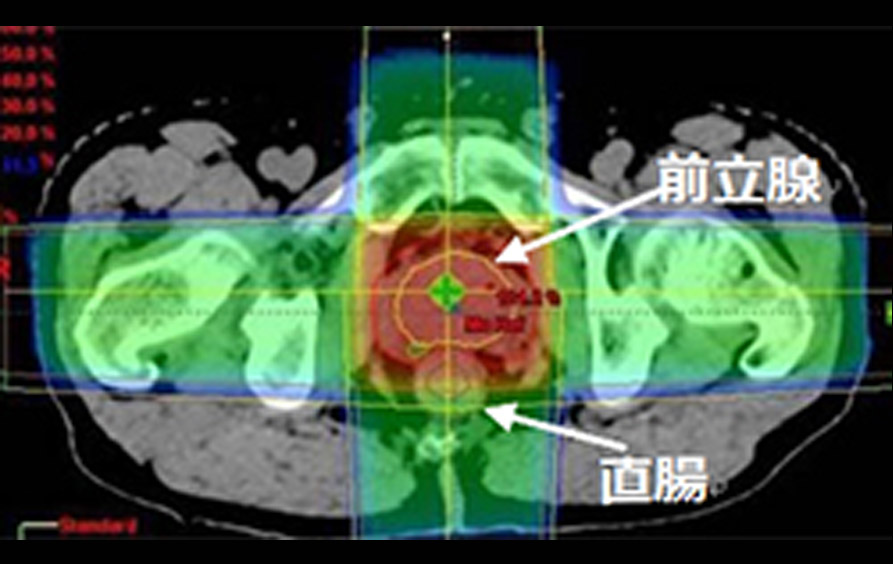 前立腺癌全摘出術後の臨床的再発