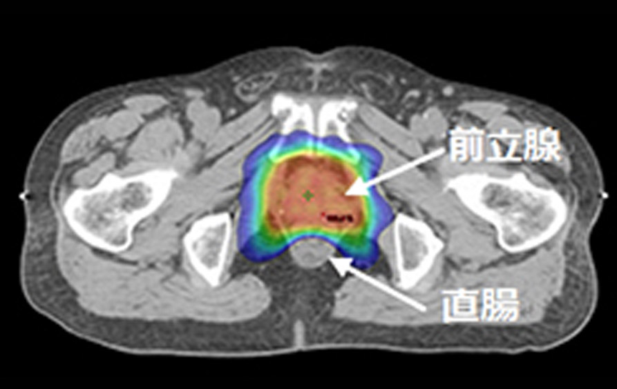 前立腺癌全摘出術後の臨床的再発