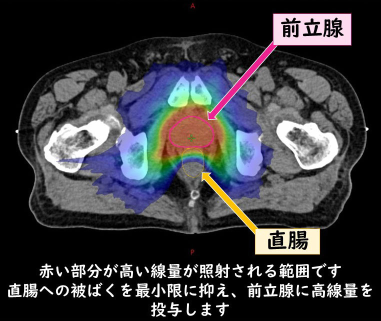 前立腺癌の放射線治療