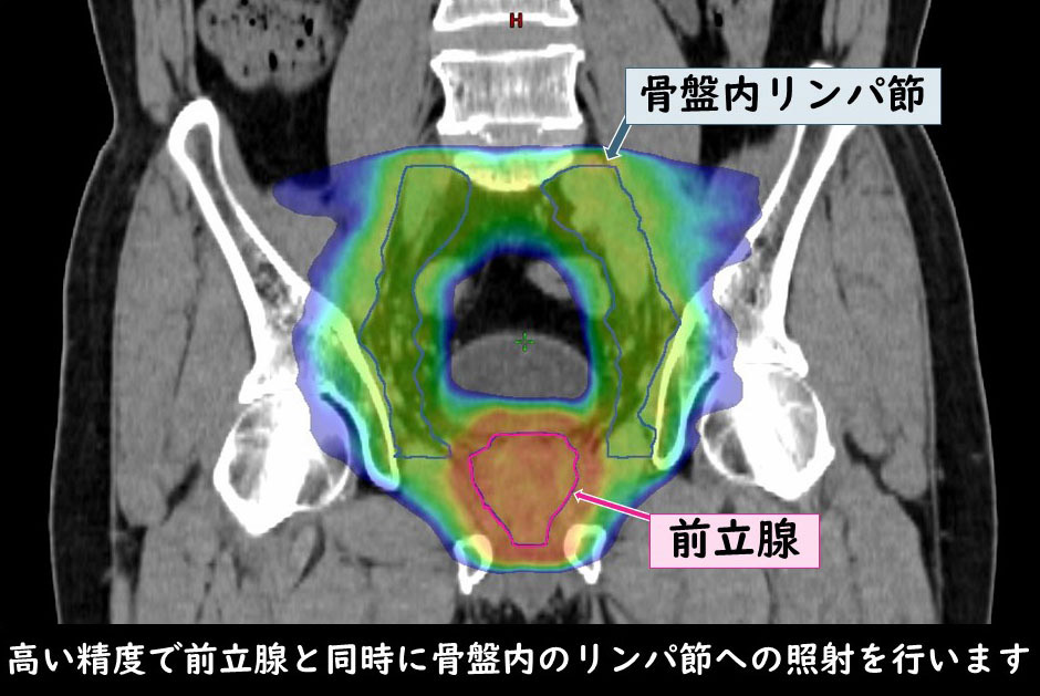 マルチリーフコリメータ（MLC）