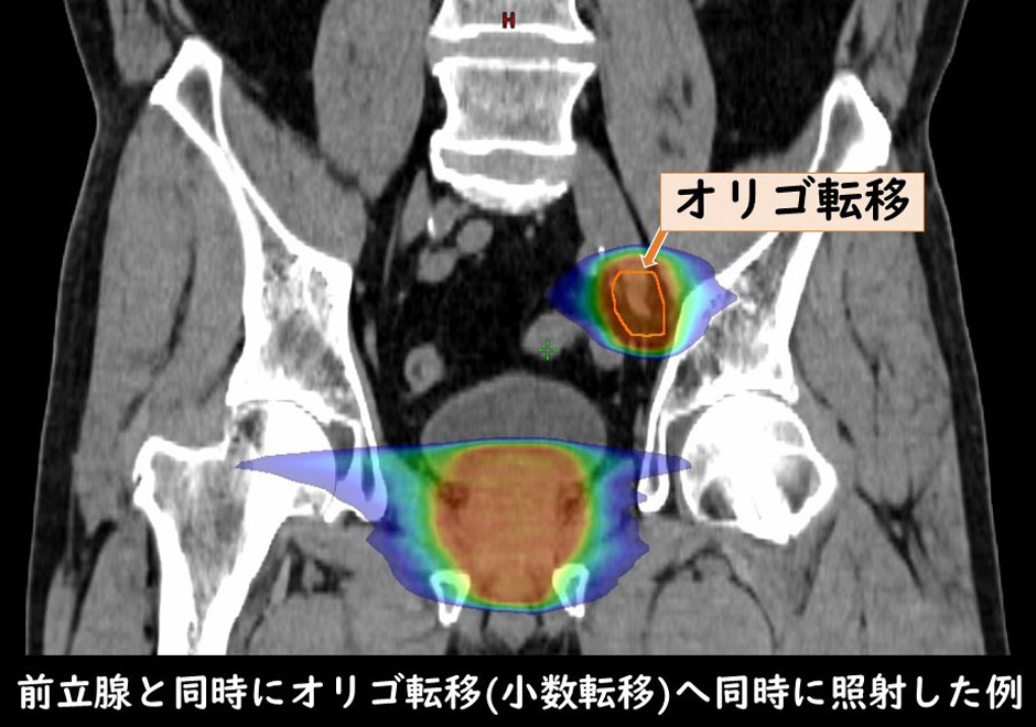 マルチリーフコリメータ（MLC）